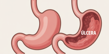 Ferida Invisível: Como a Úlcera Estomacal se Forma e Evolui